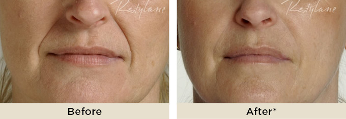 RR_rest_before_after